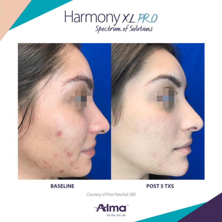 laser scar removal in kalamazoo