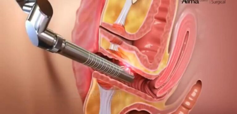 vaginal rejuvenation with FemiLift