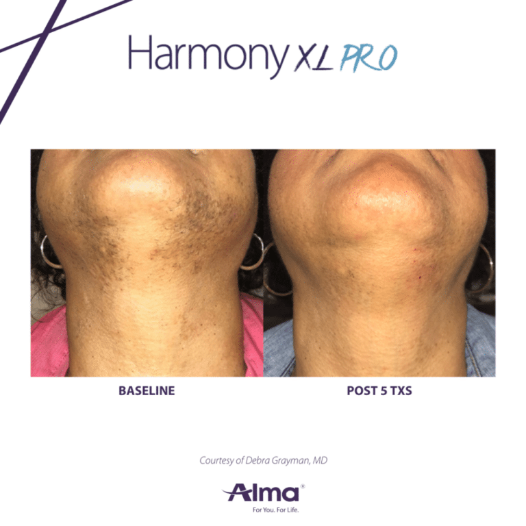 hyperpigmentation treatment