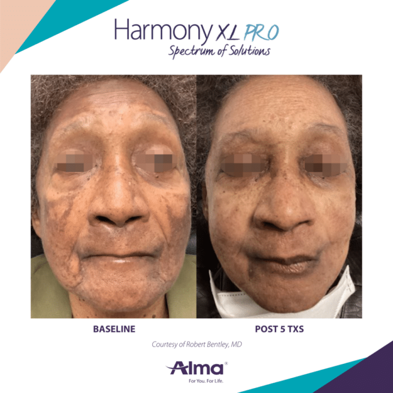 hyperpigmentation treatment kalamazoo