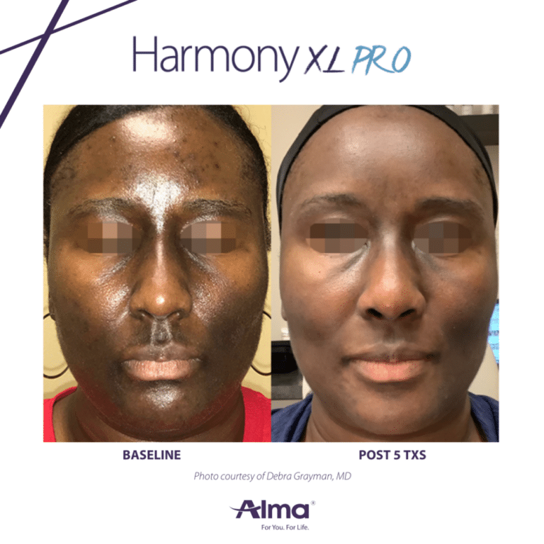 before and after of treatment of face