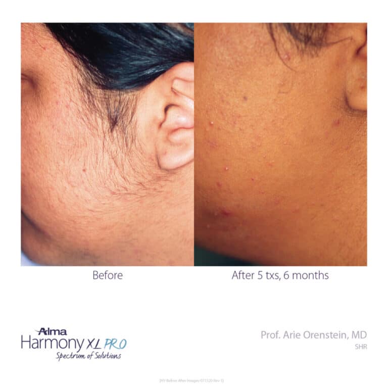 before and after of laser hair removal