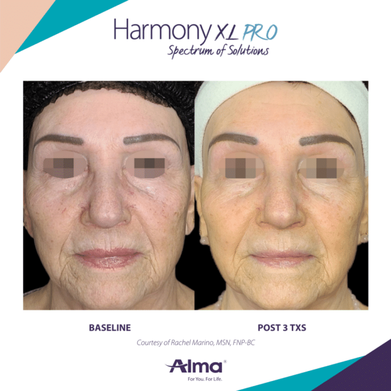 reverse aging with laser treatment - before and after.